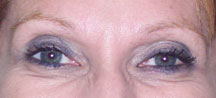 brows1763before